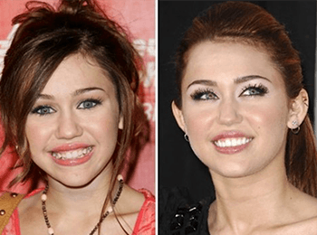 Amazing change with a great dental work