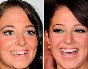 Celebrities changes their smile with dental work