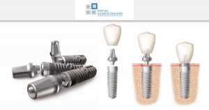 What are dental implants? – Cancun Cosmetic Dentistry