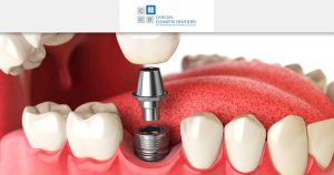 Common questions when getting Dental Implants