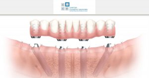 This is what you can expect when getting All-on-4 dental implants in Cancun!