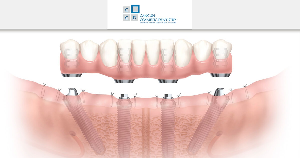 Improve your quality of life with All-on-4 implants