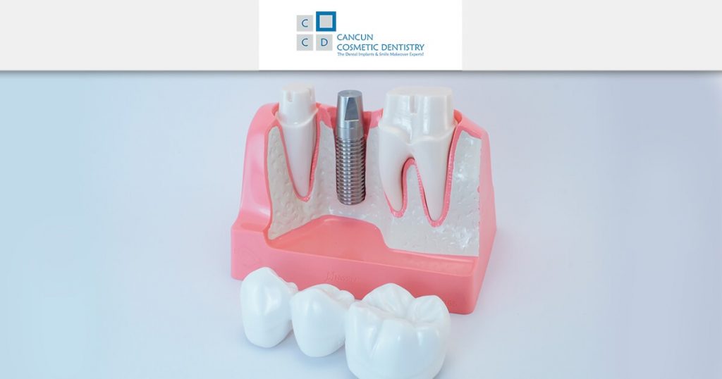 Dental Bridge vs Dental Implants? What's best for you? 