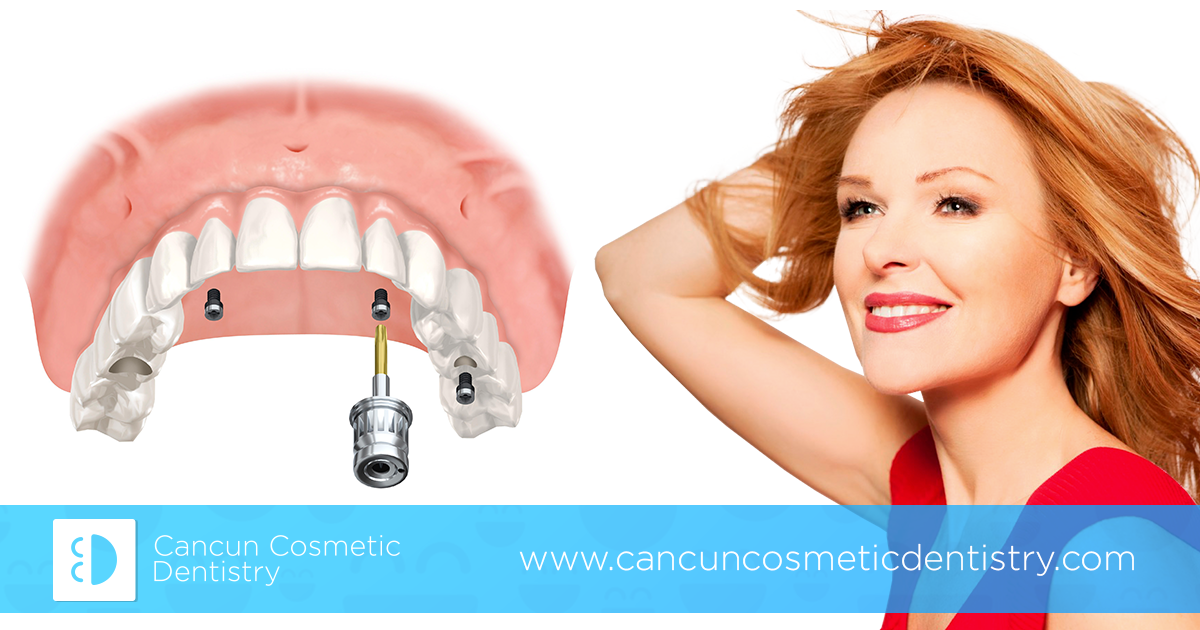 Get All-on-4 dental implants in parts in Cancun Cosmetic Dentistry!