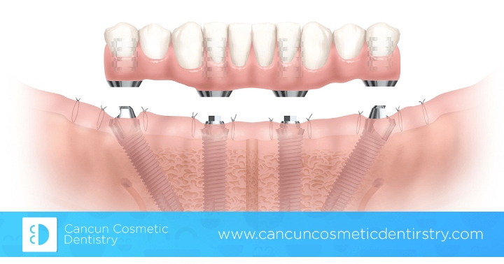 Full mouth restoration with All-on-4 or All-on-6 dental implants