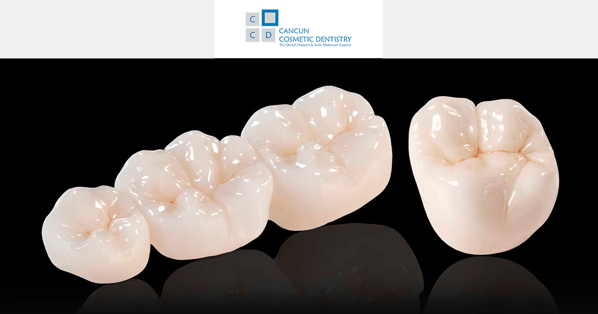 Affordable porcelain zirconia and metal free crowns