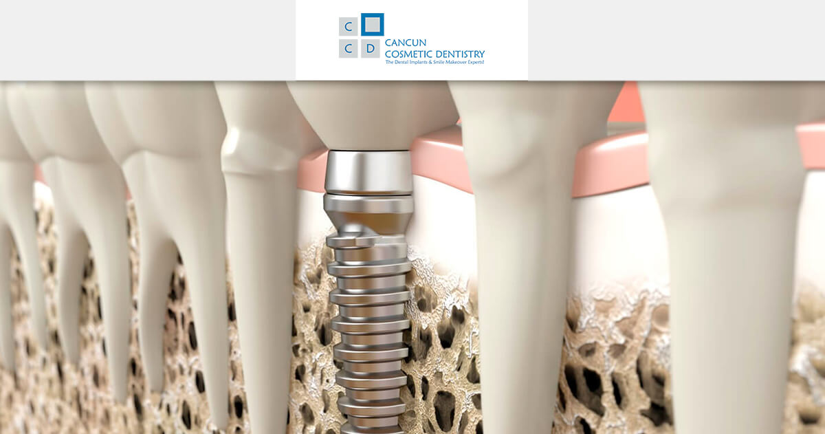 Do I need bone graft to get dental implants? - Cancun Cosmetic Dentistry