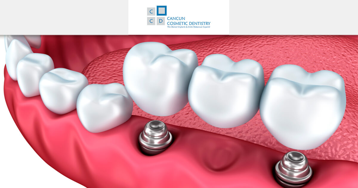 Dental Implant care and tips!