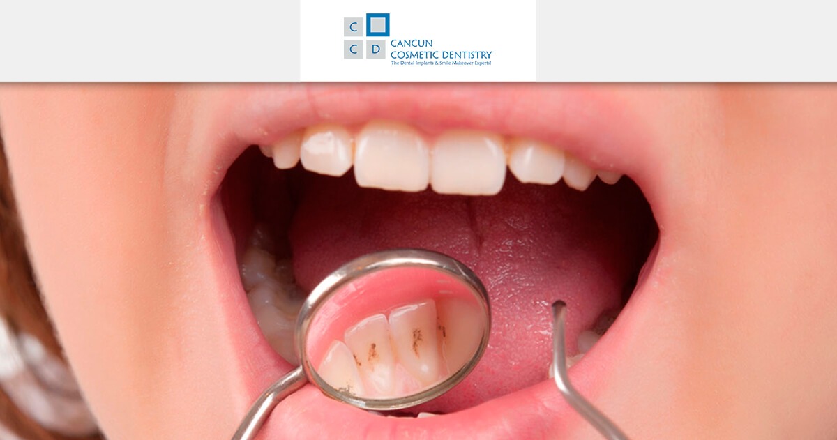 Get a dental cleaning in Cancun! It's quick and easy!