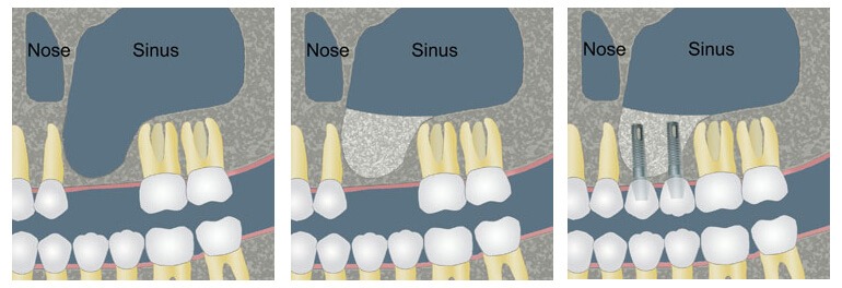 Sinus lift and Dental Implants in Cancun