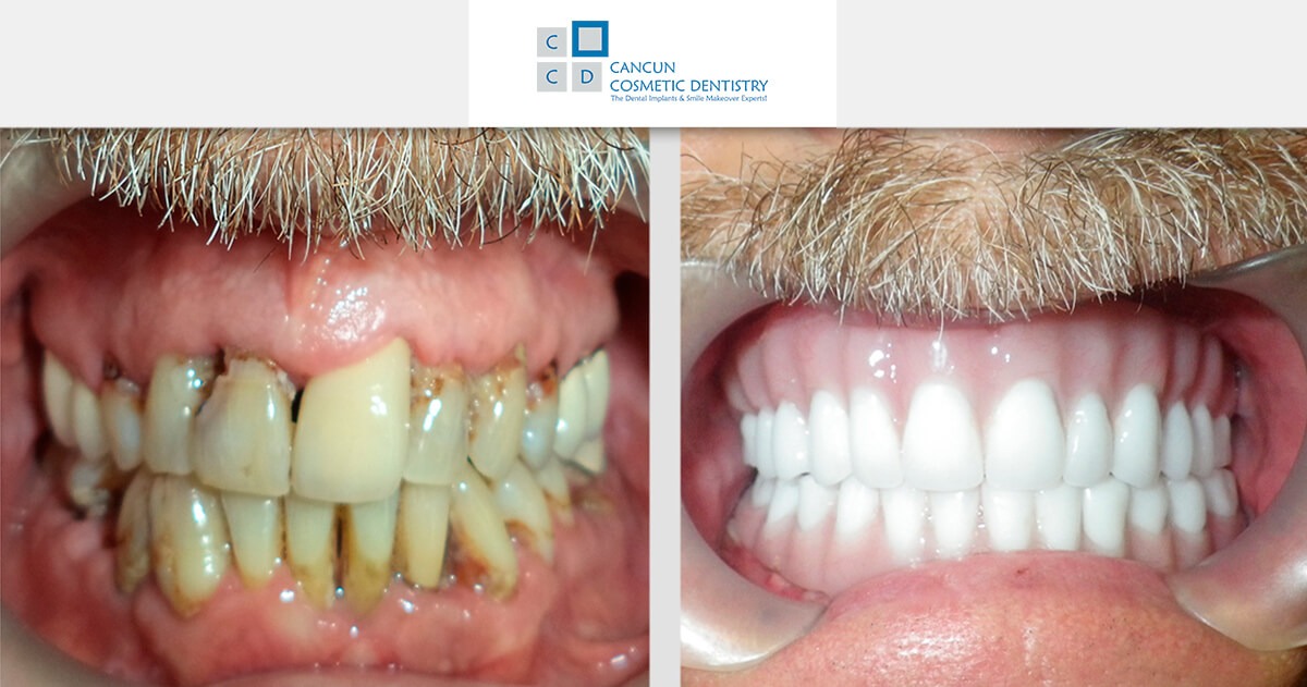 The best Snap in Dentures solution for your smile in Cancun!