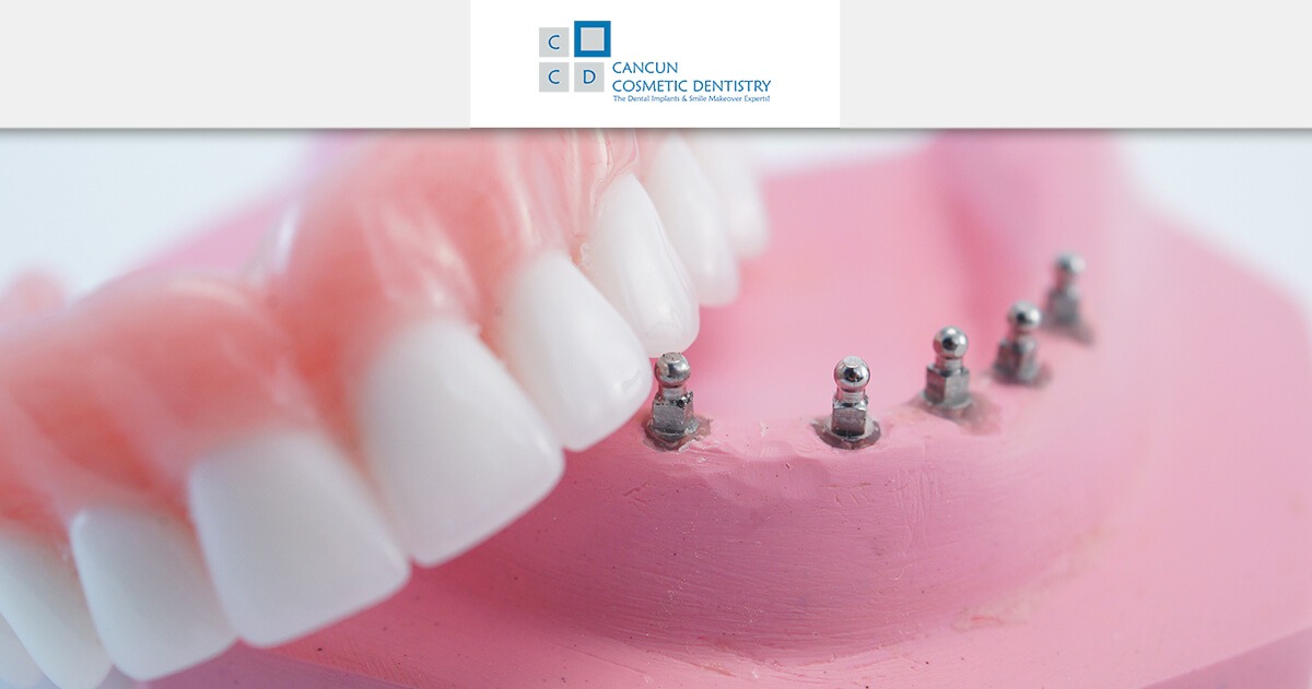 Snap in Dentures dental problem solution in Cancun