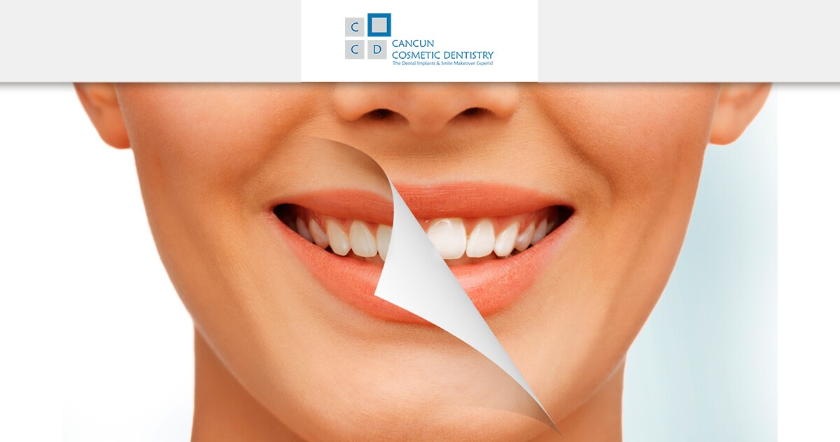 Get good teeth laser whitening for cheap in Cancun Cosmetic Dentistry