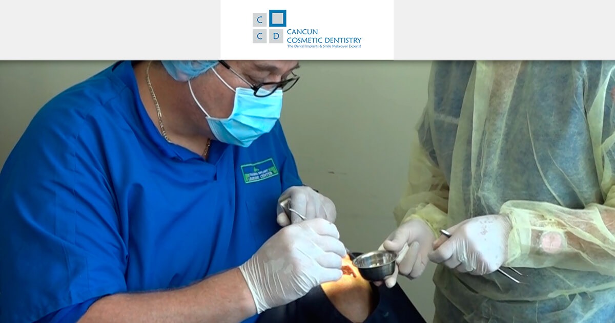 Get affordable dental implants and sinus lift in Cancun!