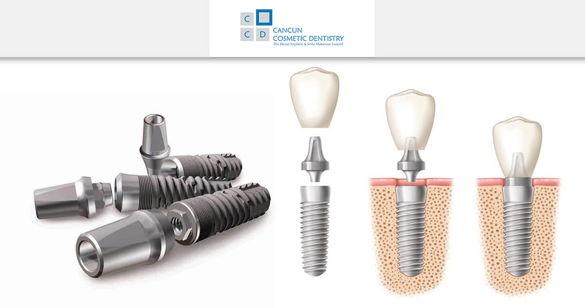 What are dental implants? - Cancun Cosmetic Dentistry