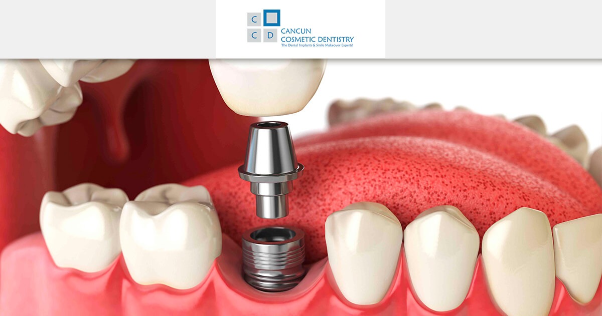 What are dental prostheses? Dental Implants, Dentures, Partials, Bars in Cancun Cosmetic Dentistry
