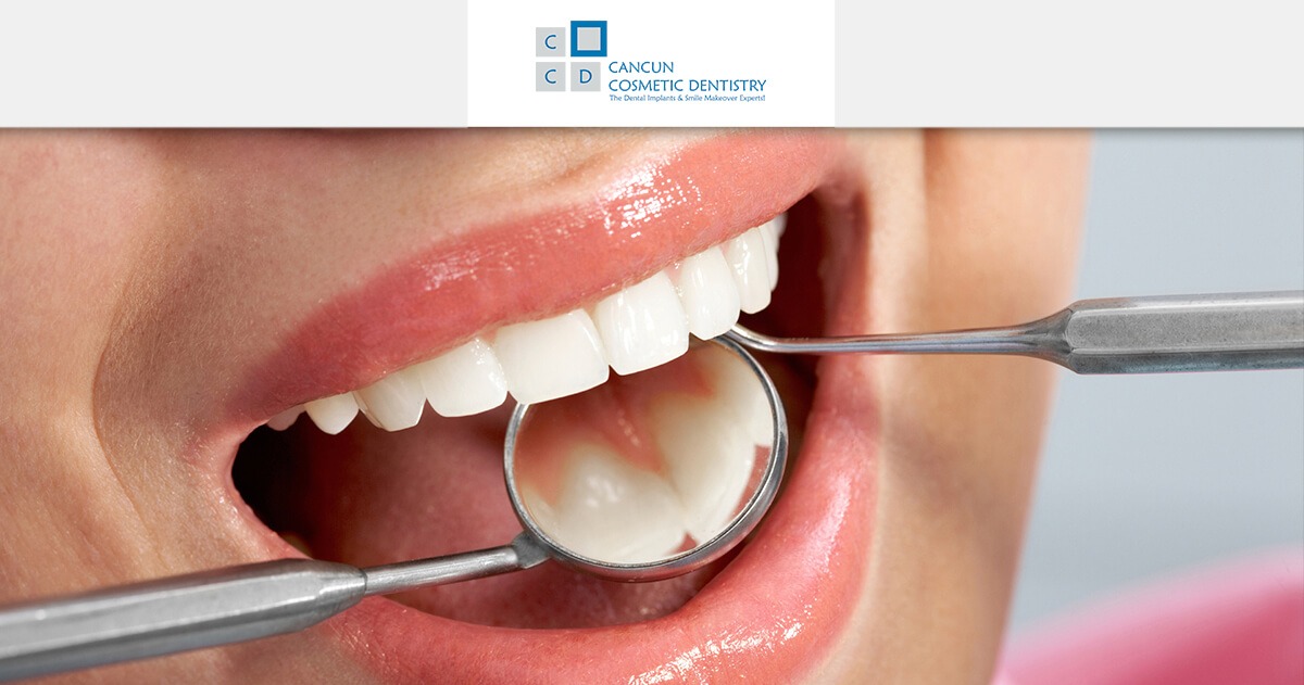 Affordable white dental resin fillings in Cancun Cosmetic Dentistry